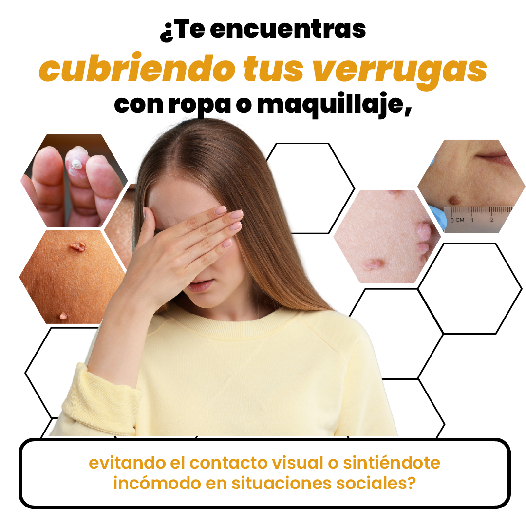 ReliefSpray™ Removedor de Verrugas